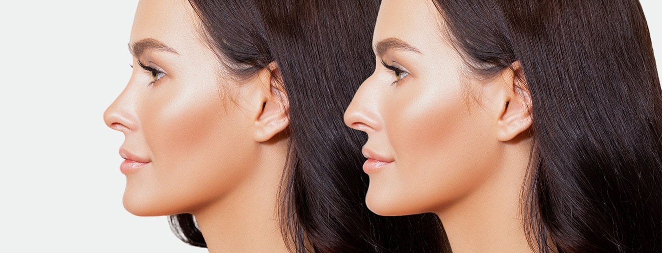 Profile of patient before and after cosmetic surgery