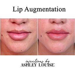 Front view of lip augmentation before after