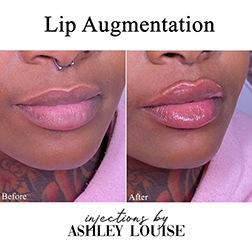 Patient's lip augmentation before after