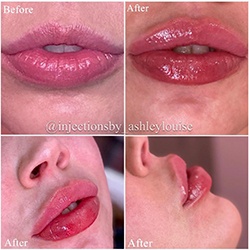 Front and side view of lip augmentation before after