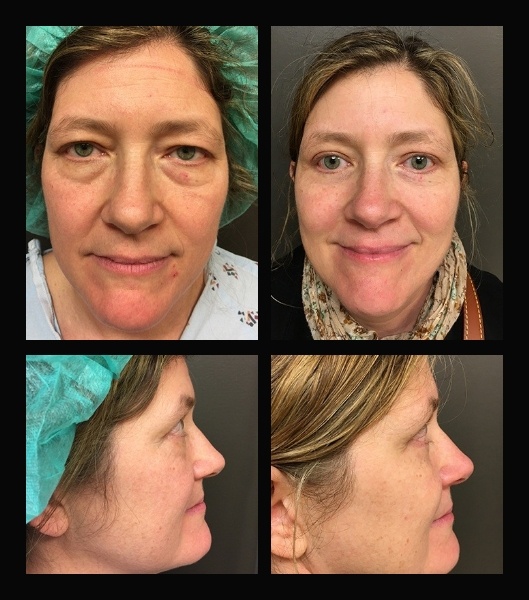 Collage of four images showing patient from the front and sides before and after blepharoplasty