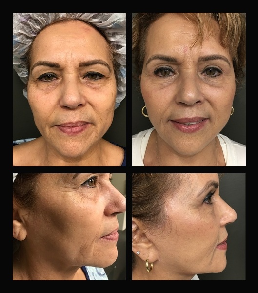 Collage of four images showing older patient from the front and sides before and after blepharoplasty