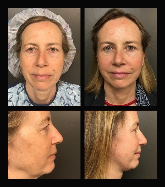Four images of woman from the front and sides before and after blepharoplasty