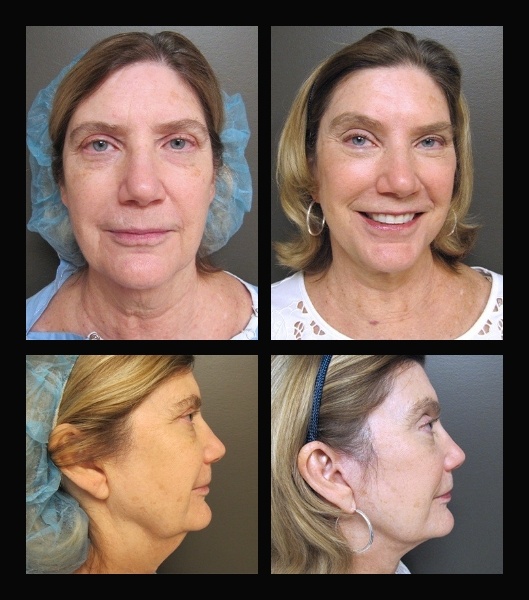 Older female patient from the front and sides before and after blepharoplasty
