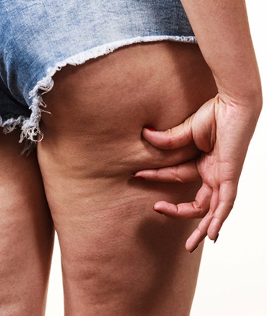 woman pinching cellulite near buttocks