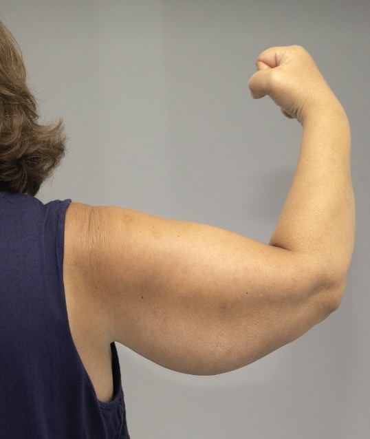 Person with sagging skin beneath arms before upper arm lift