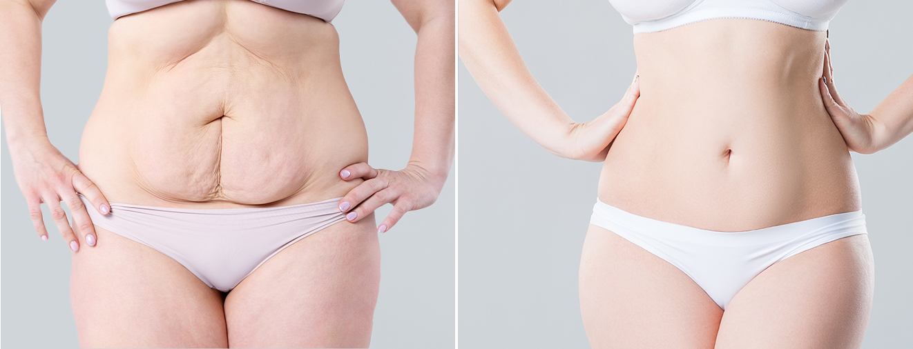 Person before and after body lift procedure
