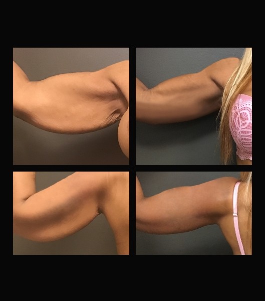 Collage of four images of patient before and after brachioplasty upper arm lift treatment