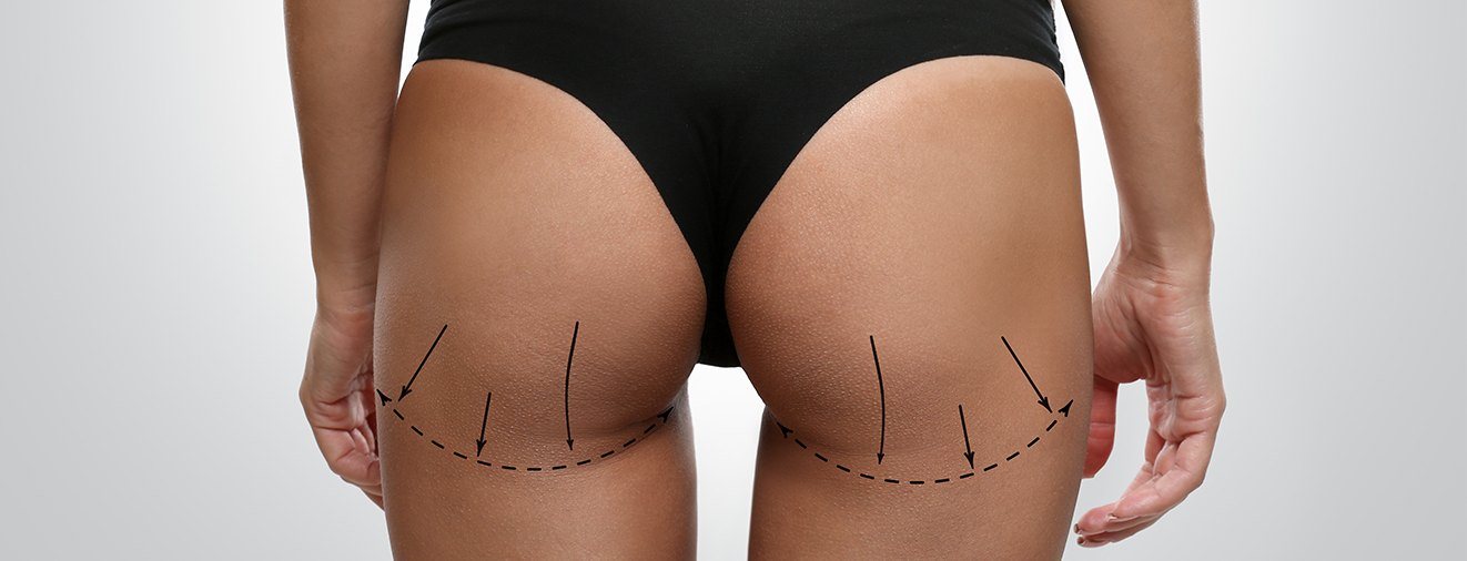 Closeup of patient with outlines over areas addressed by Brazilian butt lift