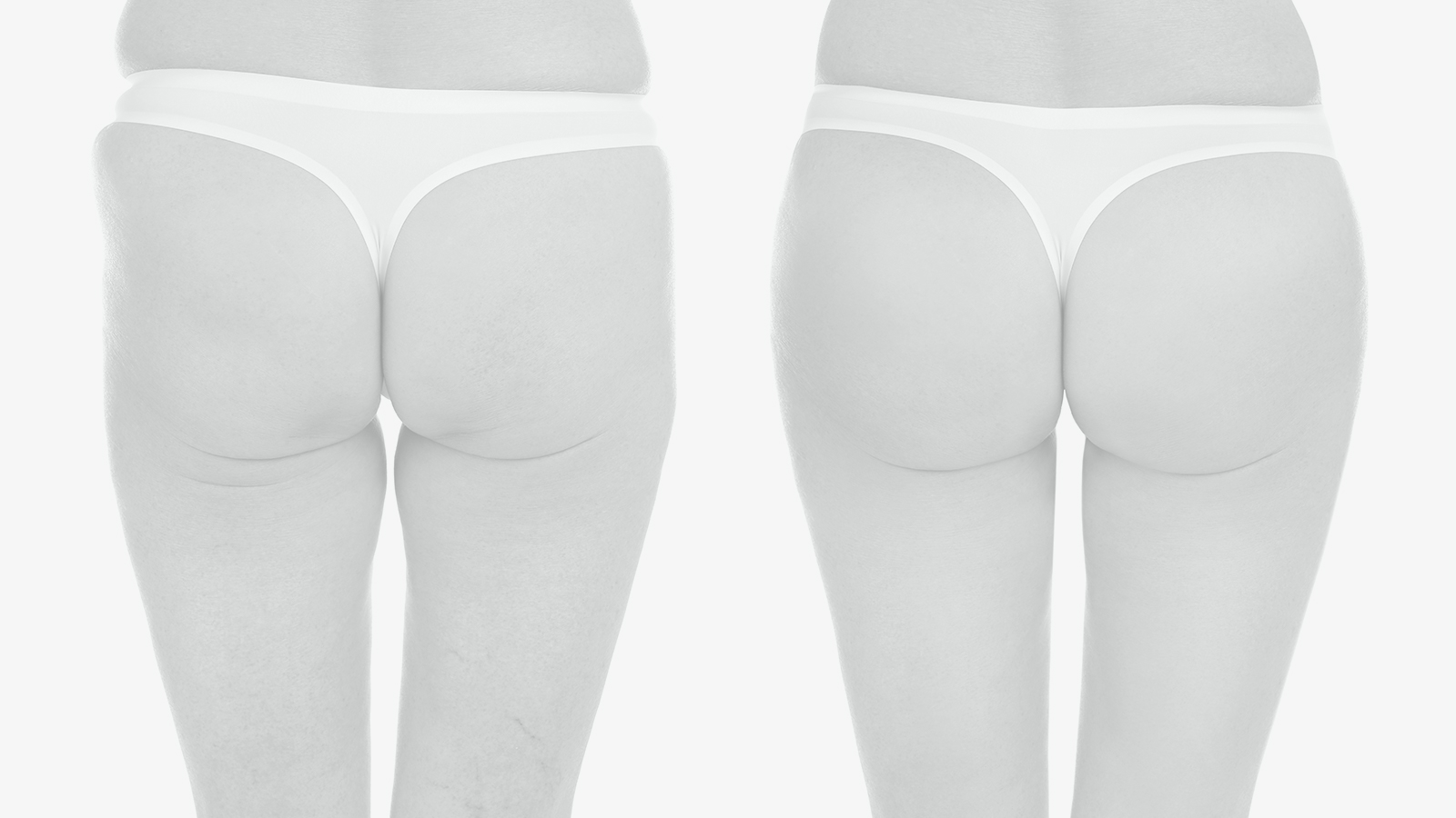 Patient before and after brazilian butt lift