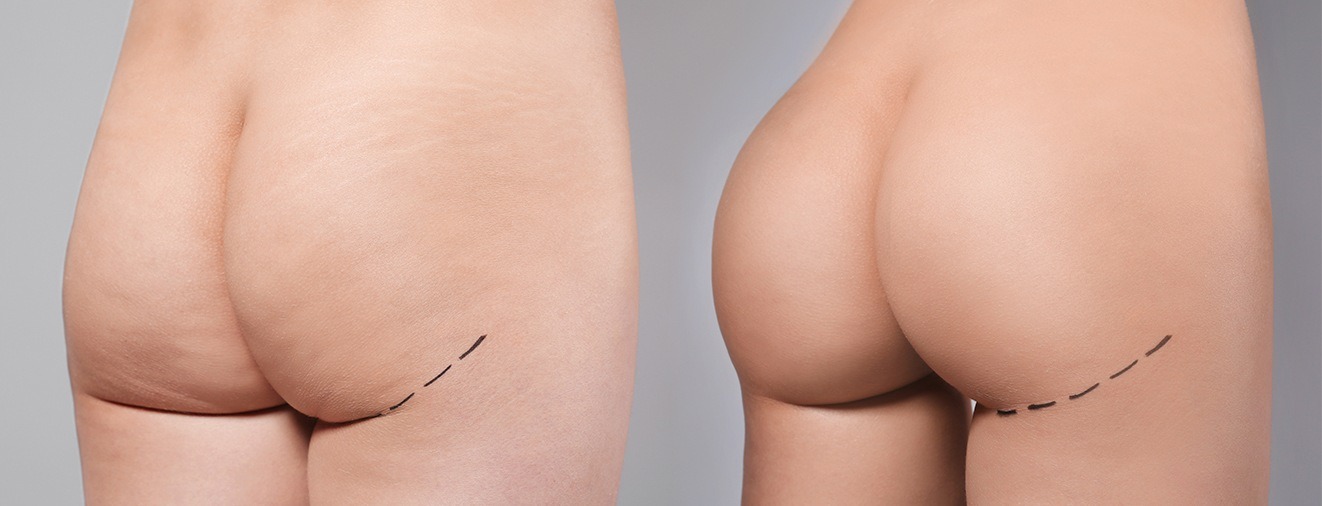 Closeup of patient before and after brazilian butt lift