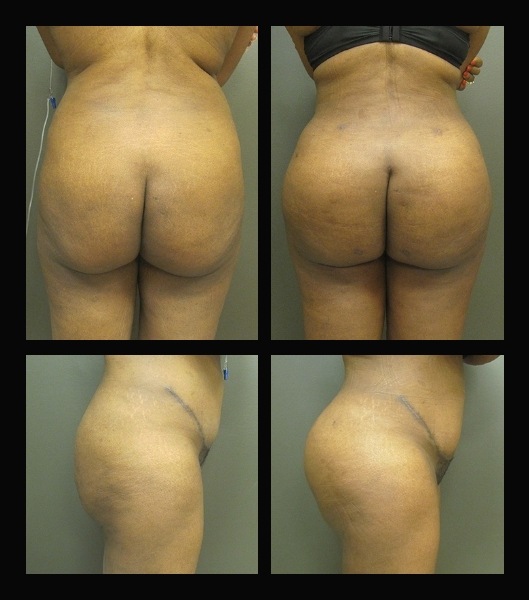 Patient from back and side before and after brazilian butt lift