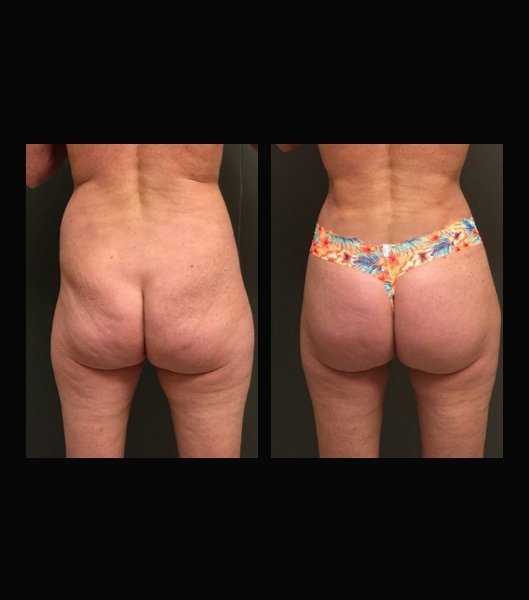 Patient from back before and after brazilian butt lift