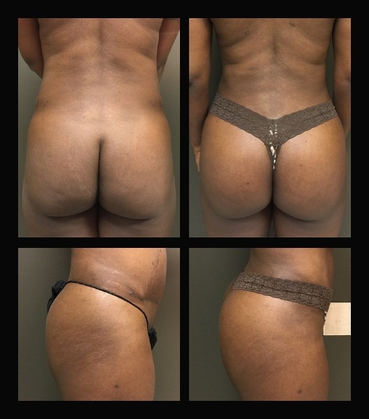 Images of patient from back and side before and after brazilian butt lift