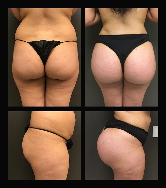 Closeup of patient from back and side before and after brazilian butt lift