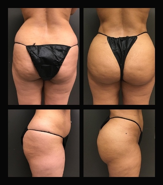 Patient from back and side before treatment and same images showing results after brazilian butt lift