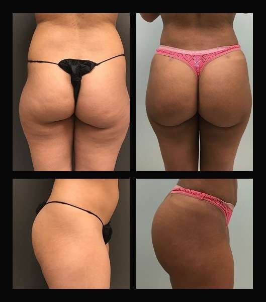 Back and side view images of patient before and after brazilian butt lift