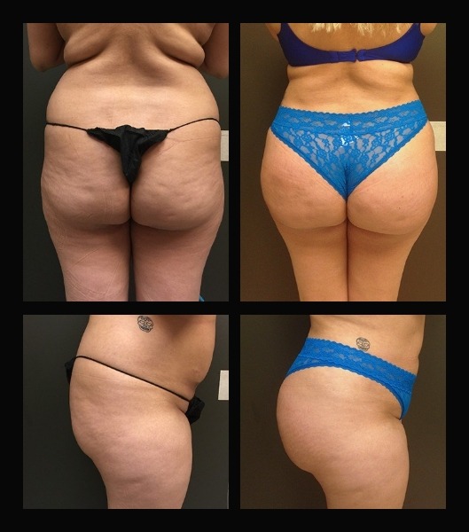 Four images of patient before and after brazilian butt lift