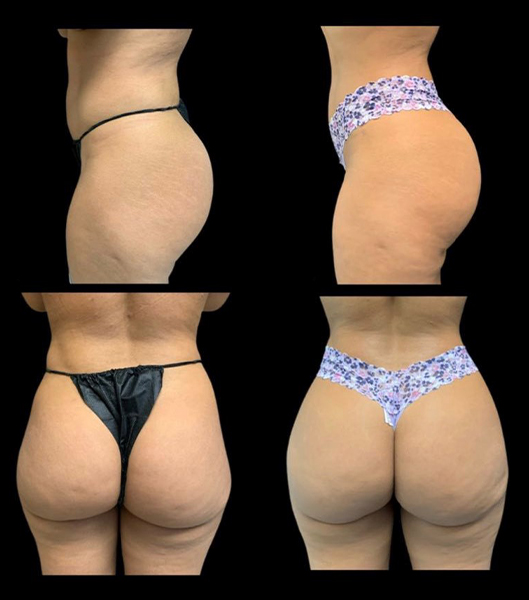 Closeup of patient's back and side before and after brazilian butt lift