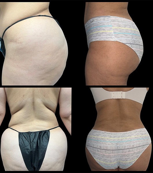 Closeup of patient's back and side before and after brazilian butt lift