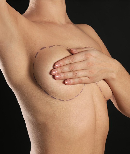 Woman's breast outlined by surgical markings before augmentation