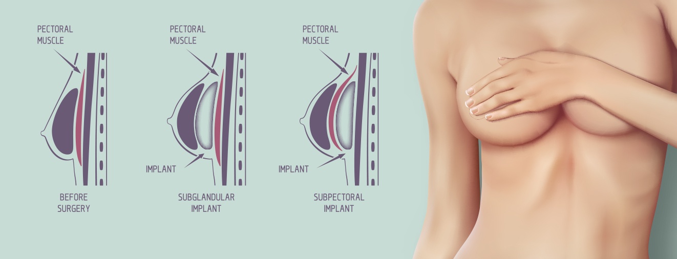 Animated depiction of the breast implant process