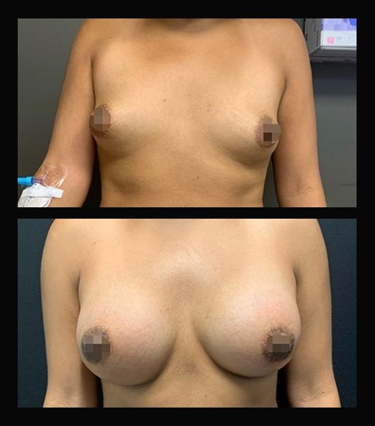 Person before and after breast implants