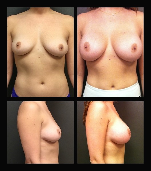 Breast augmentation patient front and side before and after treatment