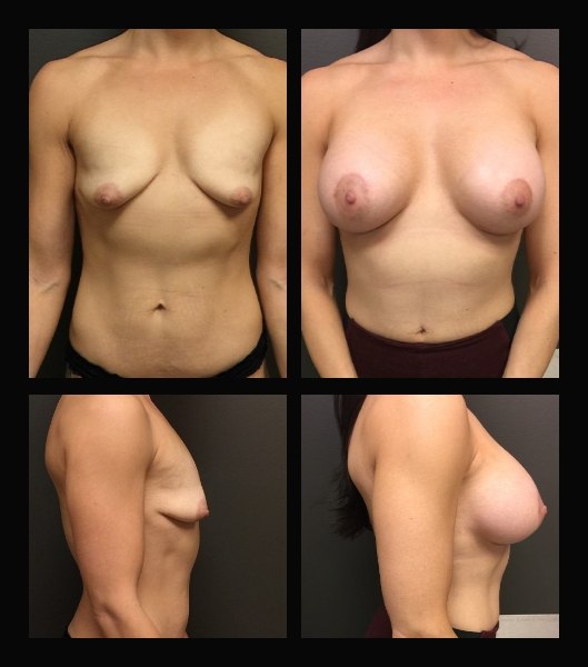 Patient front and side before and after breast augmentation treatment