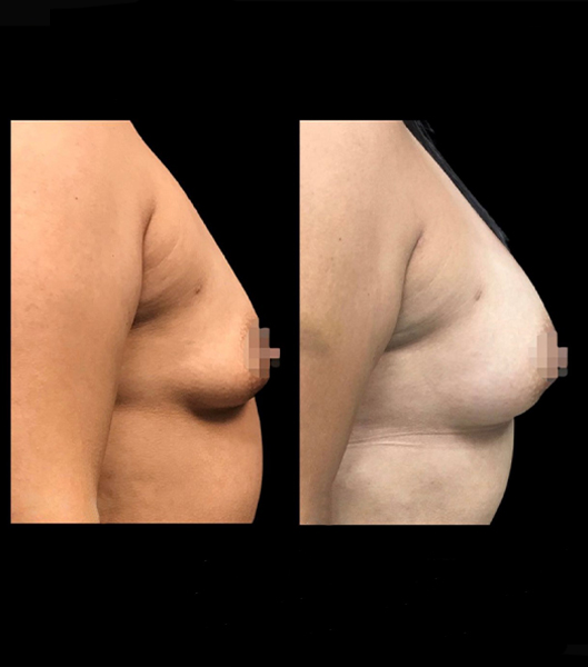 Profile of patient before and after breast augmentation