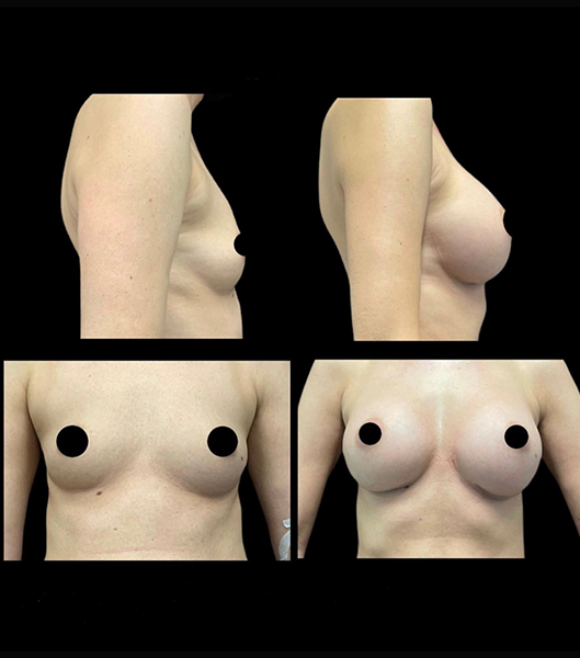 Side and front view of patient before and after breast augmentation