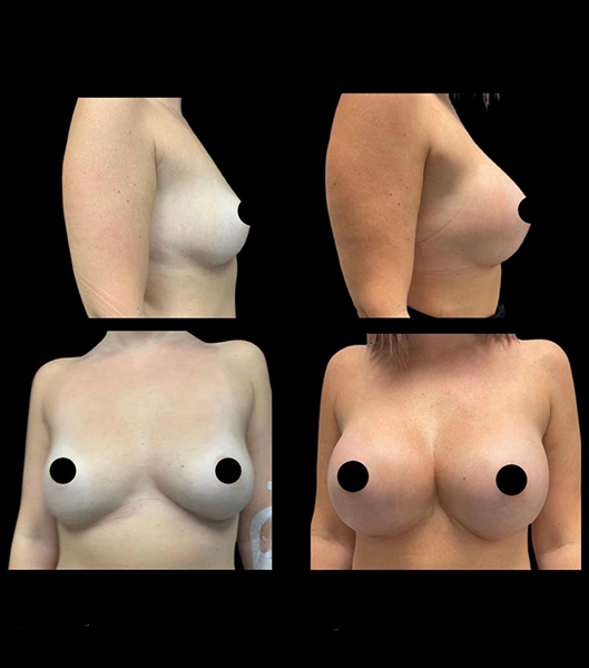 Profile and front images of patient before and after breast augmentation