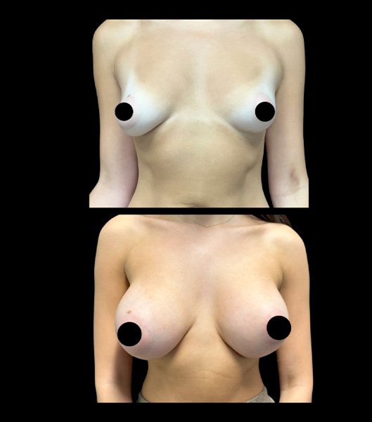 Breast augmentation patient profile and front images before and after treatment