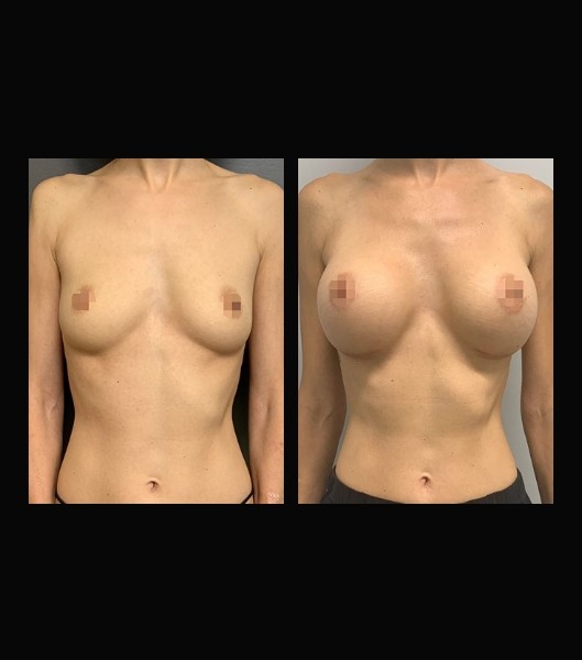 Front view of patient before and after breast implants