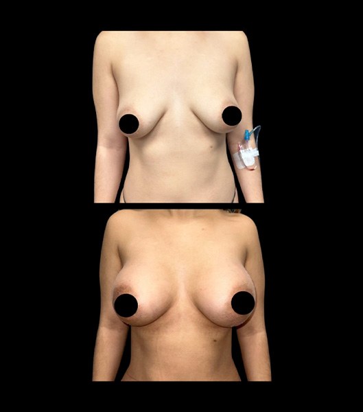 Breast augmentation patient profile and front images before and after treatment