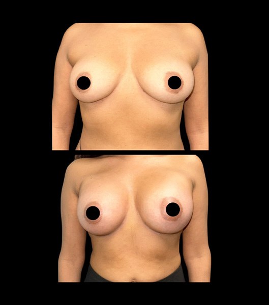 Breast augmentation patient profile and front images before and after treatment