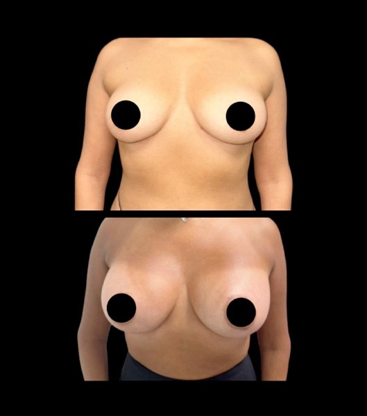 Breast augmentation patient profile and front images before and after treatment