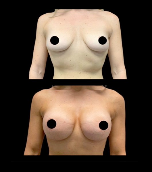 Breast augmentation patient profile and front images before and after treatment