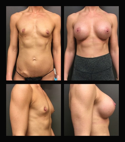 Front and side views of patient before and after breast implants