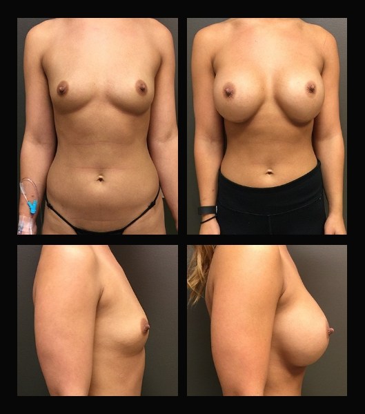 Front and side view of patient before and after breast implant procedure