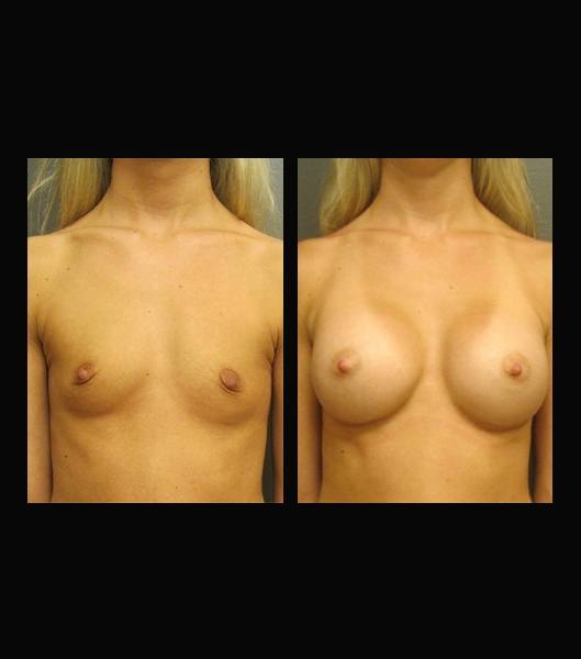 Front view of patient before and after breast implants