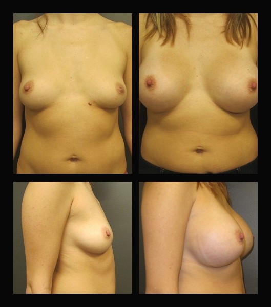 Patient front and side before and after breast augmentation