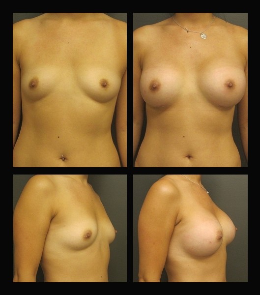 Front and side view of patient before and after breast augmentation