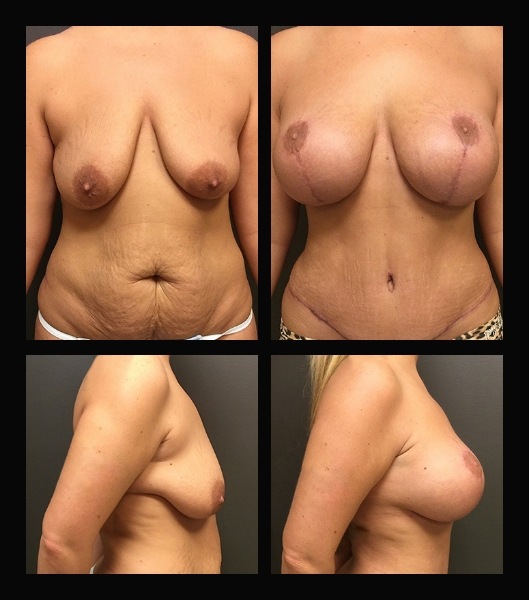 Patient before and after breast lift