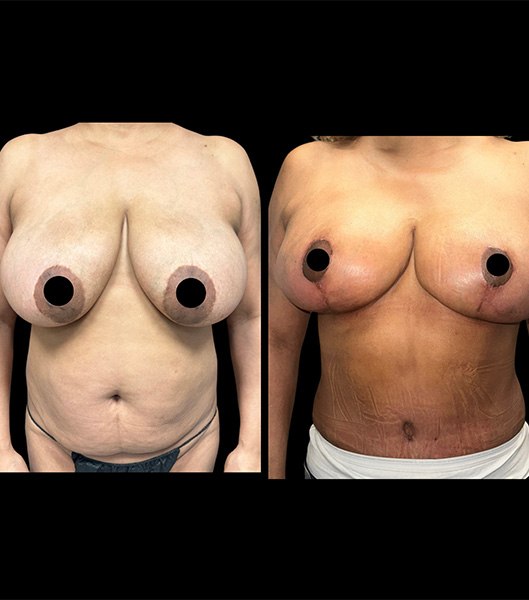 Front and side view of patient before and after breast lift procedure