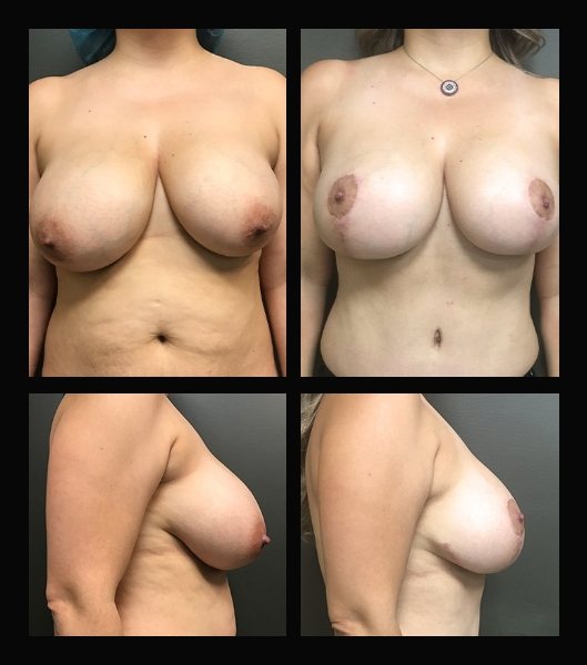 Patient front and side before and after breast lift