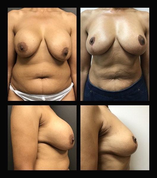 Patient before and after breast lift and reduction