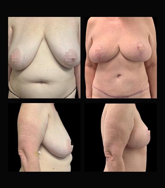 Patient before and after breast reduction and breast lift