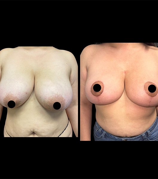 Front and side view of patient before and after breast lift procedure