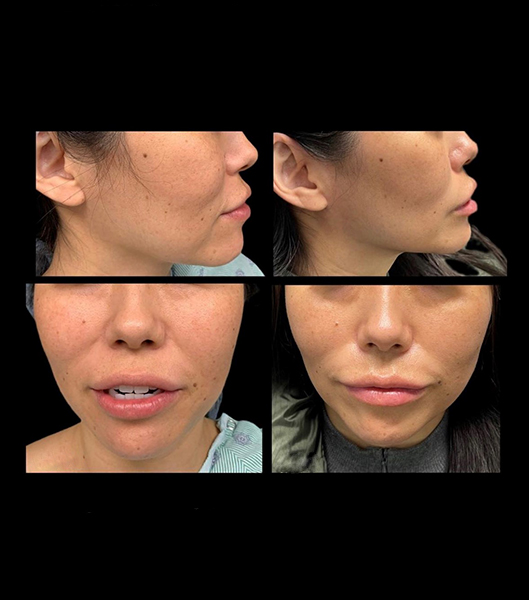 Front and side view of patient before and after buccal fat pad removal